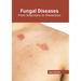 Fungal Diseases: From Infections to Prevention