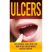 Ulcers: The Ultimate Cure Guide for How to Get Rid of Mouth Ulcers Instantly