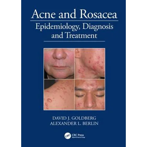 Acne and Rosacea: Epidemiology, Diagnosis and Treatment