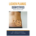 Lichen Planus Demystified Doctors Secret Guide