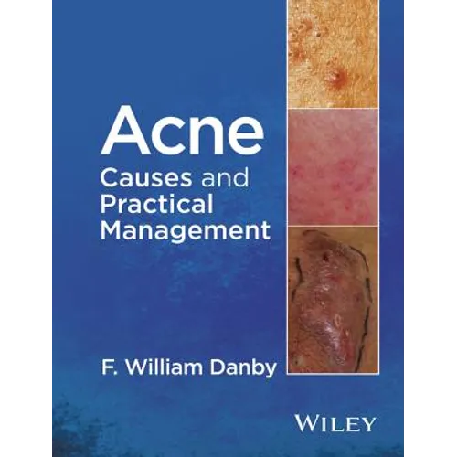 Acne: Causes and Practical Management