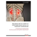 Marcadores FGF-23 Y Klotho en Enfermedad Renal Crónica y su Implicación Cardiovascular