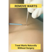 Remove Warts: Treat Warts Naturally Without Surgery: Boost Immune System To Get Rid Of Warts