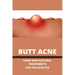 Butt Acne: Home And Natural Treatments For Folliculitis: Barber'S Itch Home Remedies