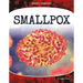 Smallpox