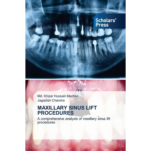 Maxillary Sinus Lift Procedures