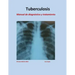 Tratamiento de Tuberculosis: Manual de diagnóstico y tratamiento