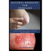 Natural Remedies for Psoriasis: A Simple and Natural Proven Solution to Get Rid of Your Skin Problem: Dermatitis, Eczema, Psoriasis & Rosacea and Othe