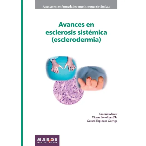 Avances en esclerosis sistémica (esclerodermia)