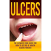 Ulcers: The Ultimate Cure Guide for How to Get Rid of Mouth Ulcers Instantly