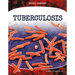 Tuberculosis