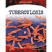 Tuberculosis