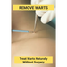 Remove Warts: Treat Warts Naturally Without Surgery: Boost Immune System To Get Rid Of Warts