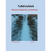 Tratamiento de Tuberculosis: Manual de diagnóstico y tratamiento