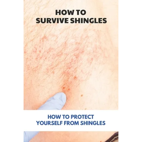 How To Survive Shingles: How To Protect Yourself From Shingles: How To Speed Up Shingles Recovery - Paperback