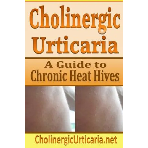 Cholinergic Urticaria: A Guide to Chronic Heat Hives