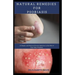 Natural Remedies for Psoriasis: A Simple and Natural Proven Solution to Get Rid of Your Skin Problem: Dermatitis, Eczema, Psoriasis & Rosacea and Othe
