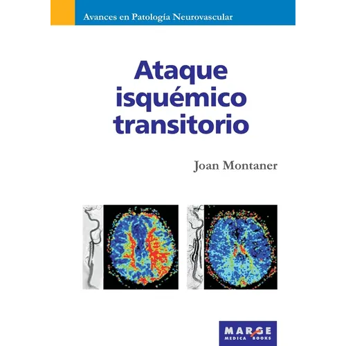 Ataque isquémico transitorio