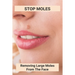Stop Moles: Removing Large Moles From The Face: Surefire Way To Get Rid Of Moles